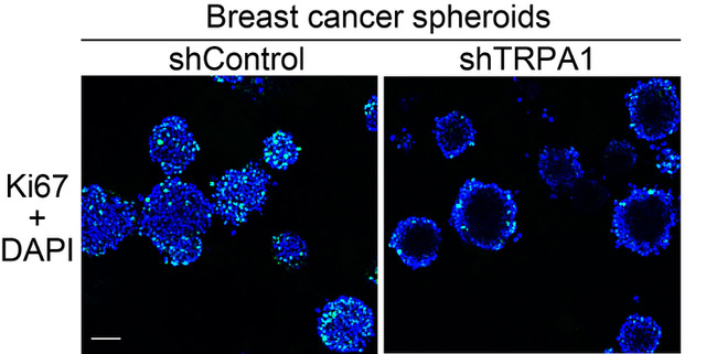 Breast cancer spheroids